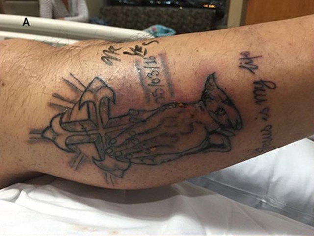 Man dies of infection after swimming in ocean with new tattoo