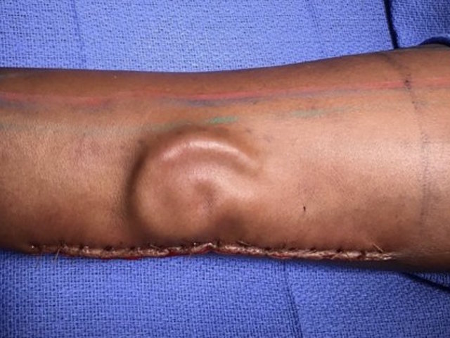 After soldier lost ear, doctors grew her a new one -- in her forearm